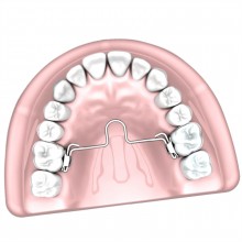 Barra Palatina com Loop Mesial -30.30.045 - 45mm - Morelli