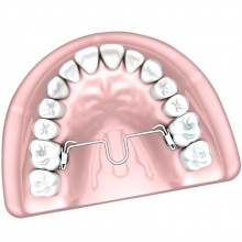 Barra Palatina com Loop Mesial -30.30.149- 49mm - Morelli