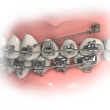 Microimplante Ortodontico Extrarradicular de Aço 7mm 37.10.407 - Morelli*